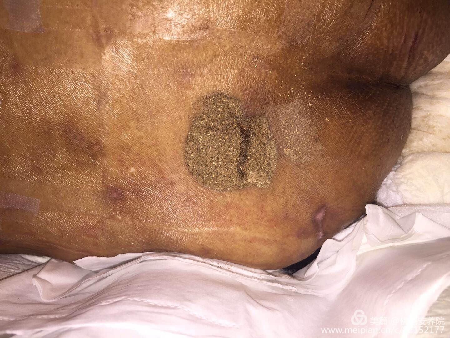 压疮的预防与护理
